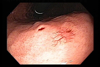 Ulceración de Dieulafoy